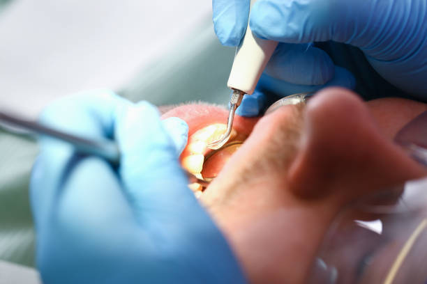 Best Emergency Root Canal Treatment in Evansville, WY